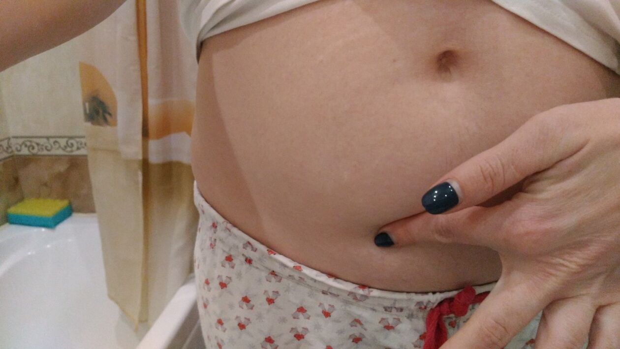 Signes d'infection helminthique d'après une expérience personnelle.